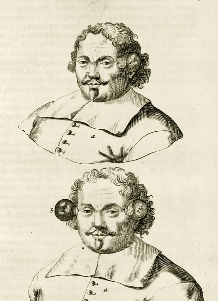 Un esempio di coppettazione, dagli esercizi pratici per curare il