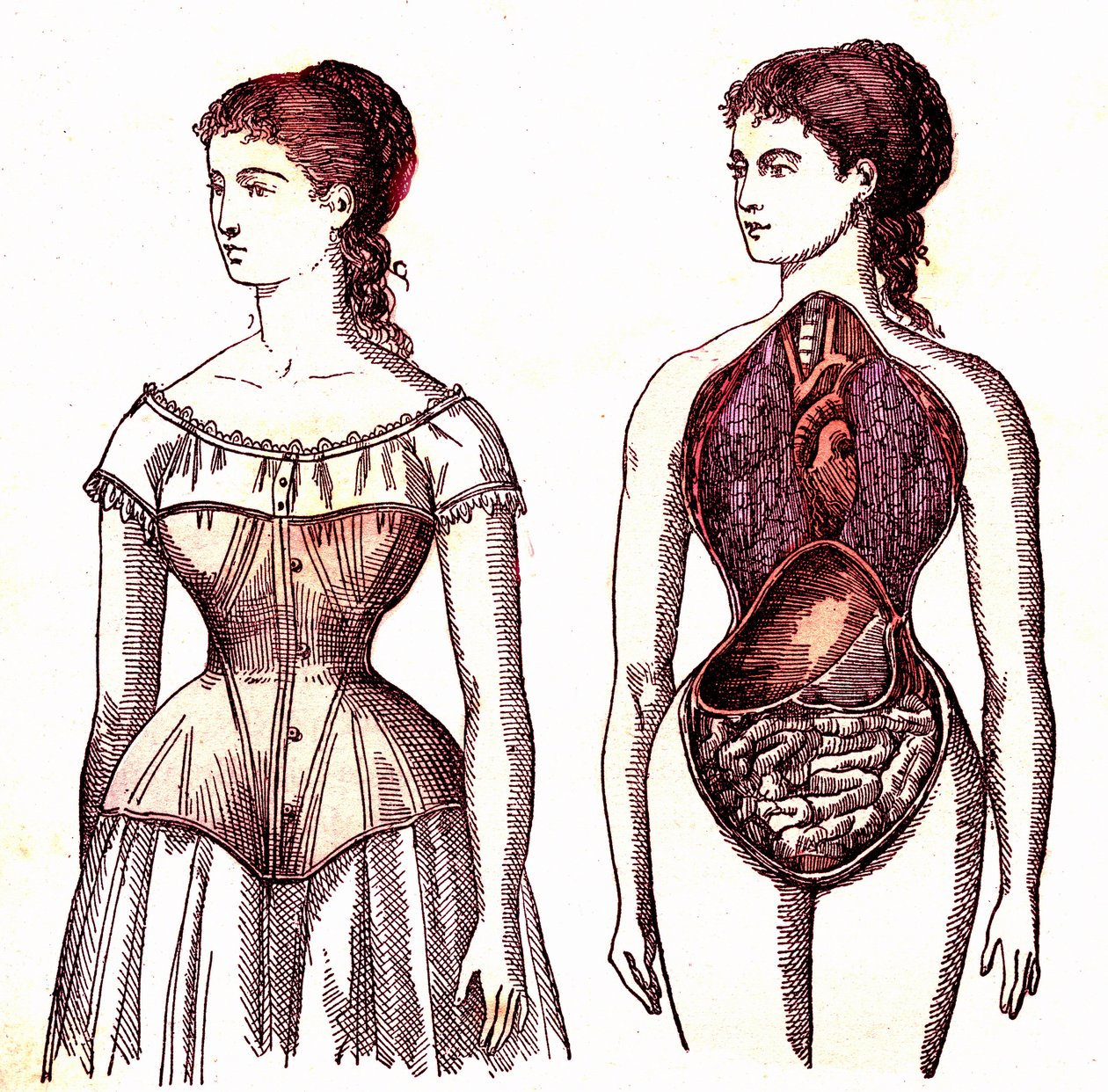 Compressione del corsetto - La vita normale e la salute di J. Rengade. Disegno di A. Demarle 1881 da Alphonse Demarle