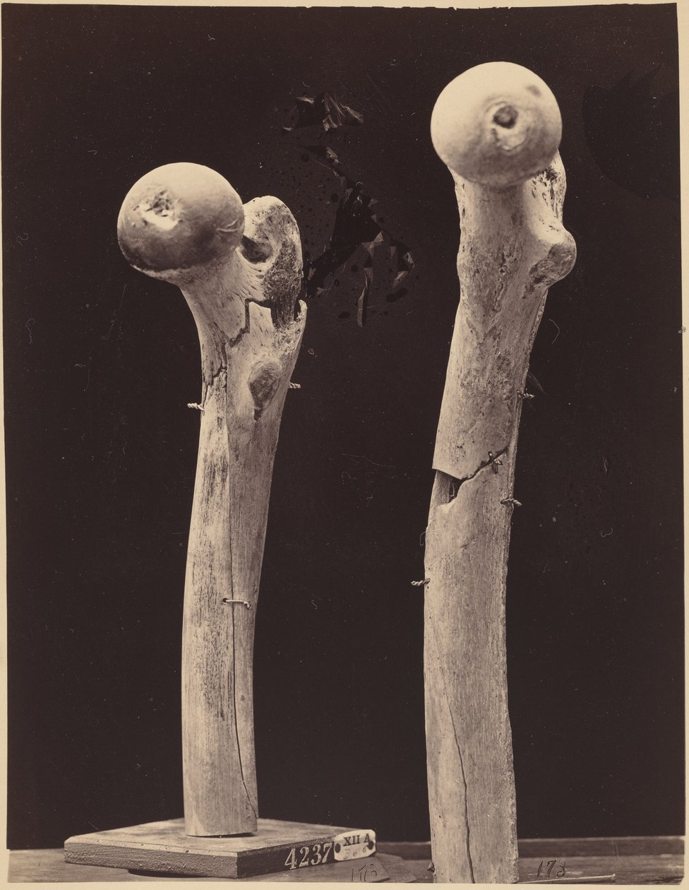 Esemplari di fratture da arma da fuoco del femore, c. 1867 (foto) da American Photographer
