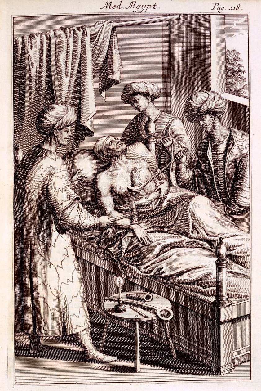 Illustrazione della moxibustione da Medicina Aegyptorum di Prospero Alpinus, 1745 da American School
