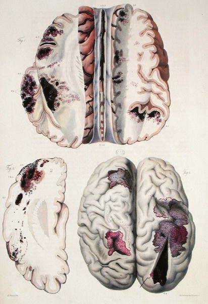 Apoplessia capillare, da 