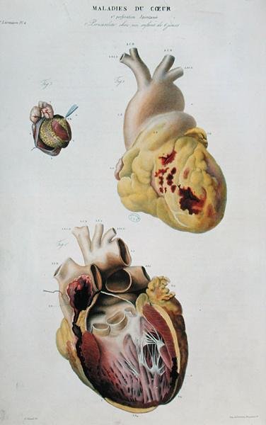 Tavola raffigurante malattie cardiache. Rottura spontanea del cuore di una donna di 86 anni e pericardite in un neonato di sei giorni, da 