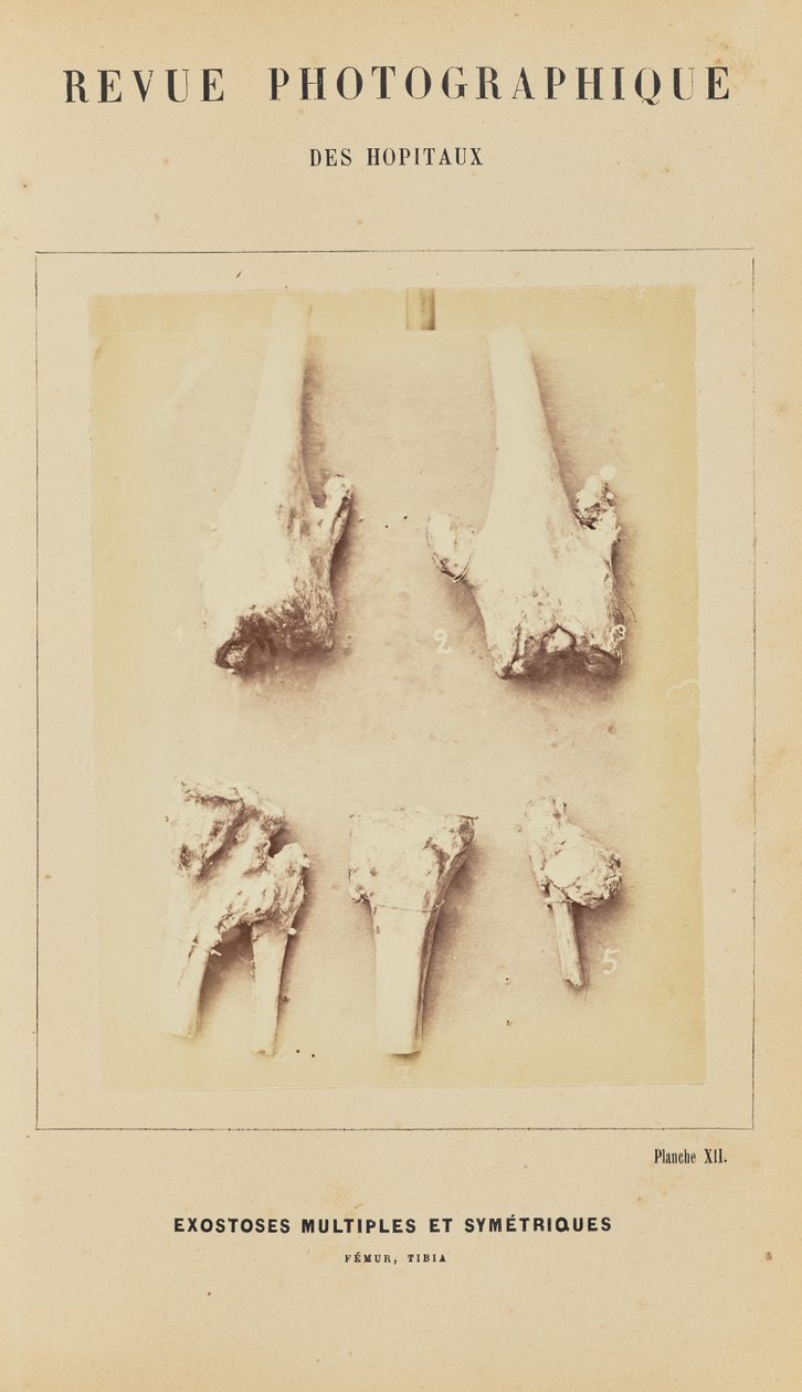 Esostosi multiple simmetriche, femore, tibia da Arthur de Montmeja