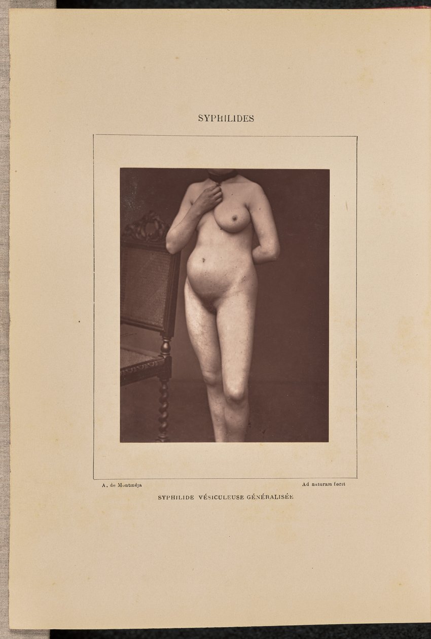 Sifilide vescicolare generalizzata da Arthur de Montmeja