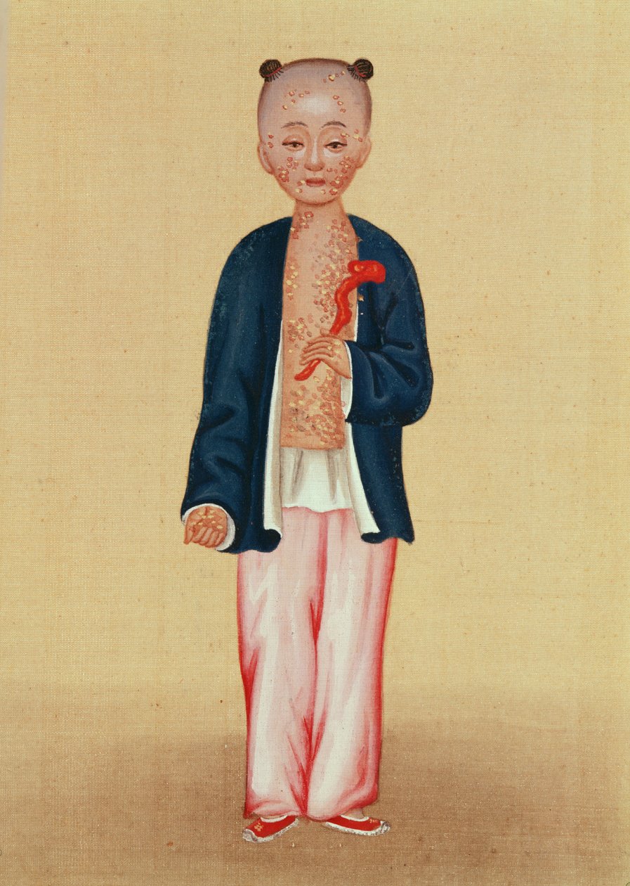 Bambino con vaiolo da Chinese School