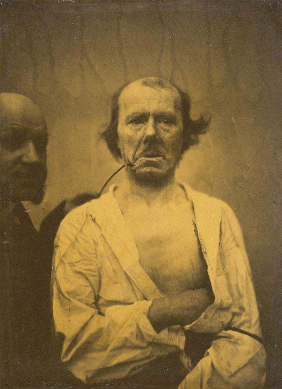 Espressione rilassata a sinistra, Disgusto a destra, 1854-1856, stampato 1862 da Duchenne de Boulogne