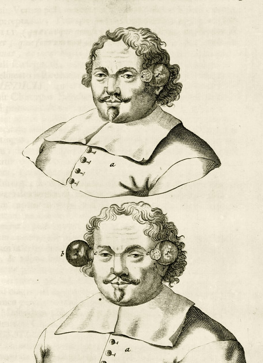 Un esempio di coppettazione, da Exercitationes Practicae circa Medendi Methodum di Frederik Dekkers, 1694 da Dutch School