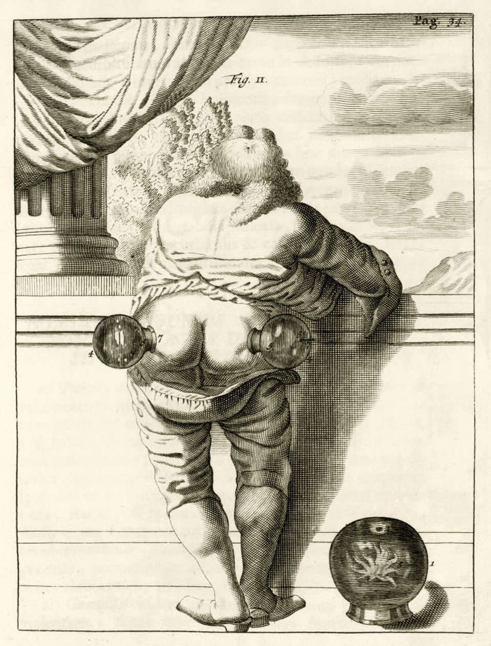 Un esempio di coppettazione, da Exercitationes Practicae circa Medendi Methodum di Frederik Dekkers, 1694 da Dutch School