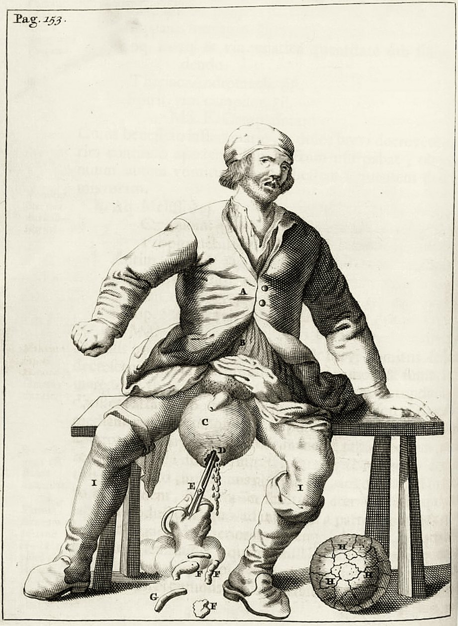Drenaggio di liquido da un idrocele dello scroto, da Exercitationes Practicae circa Medendi Methodum di Frederik Dekkers, 1694 da Dutch School
