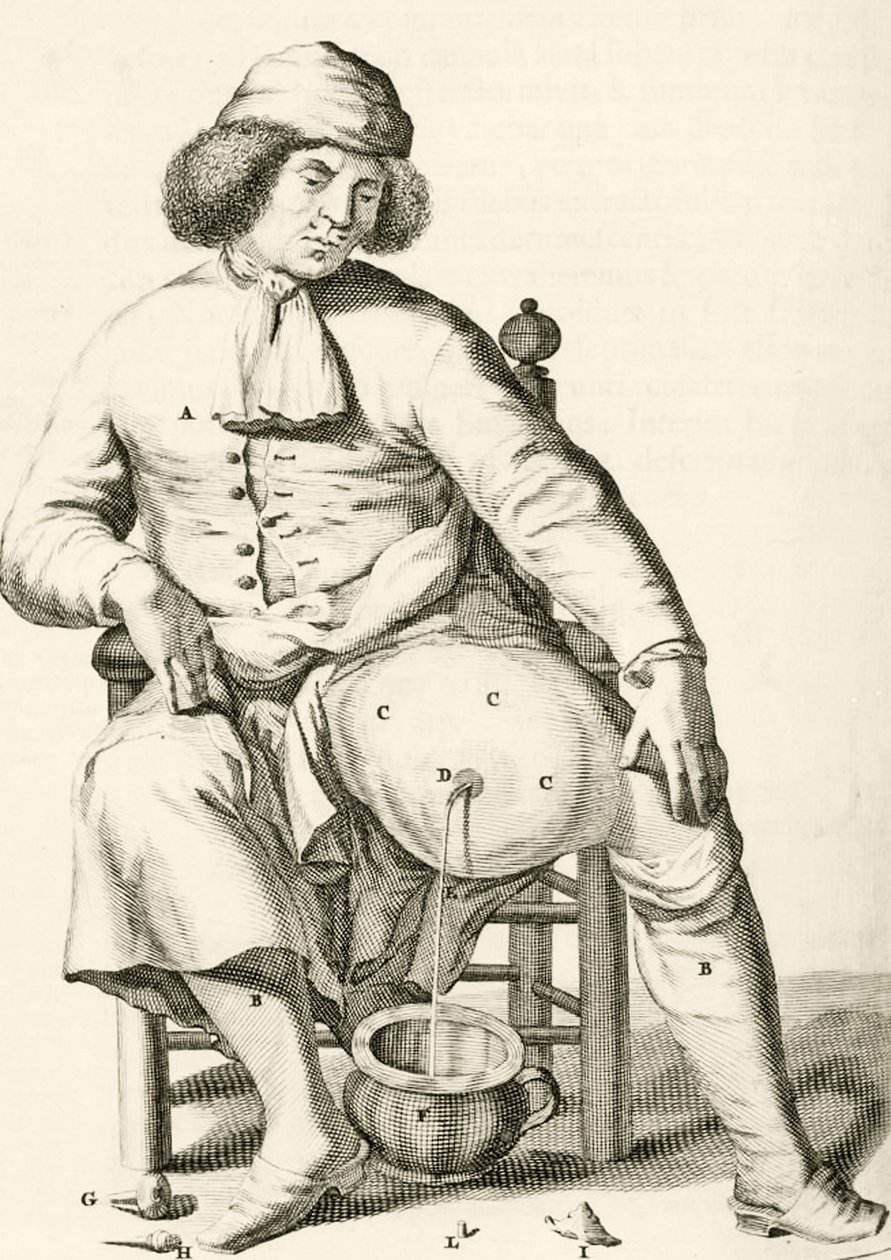 Drenaggio di liquido da un ascesso, da Exercitationes Practicae circa Medendi Methodum di Frederik Dekkers, 1694 da Dutch School