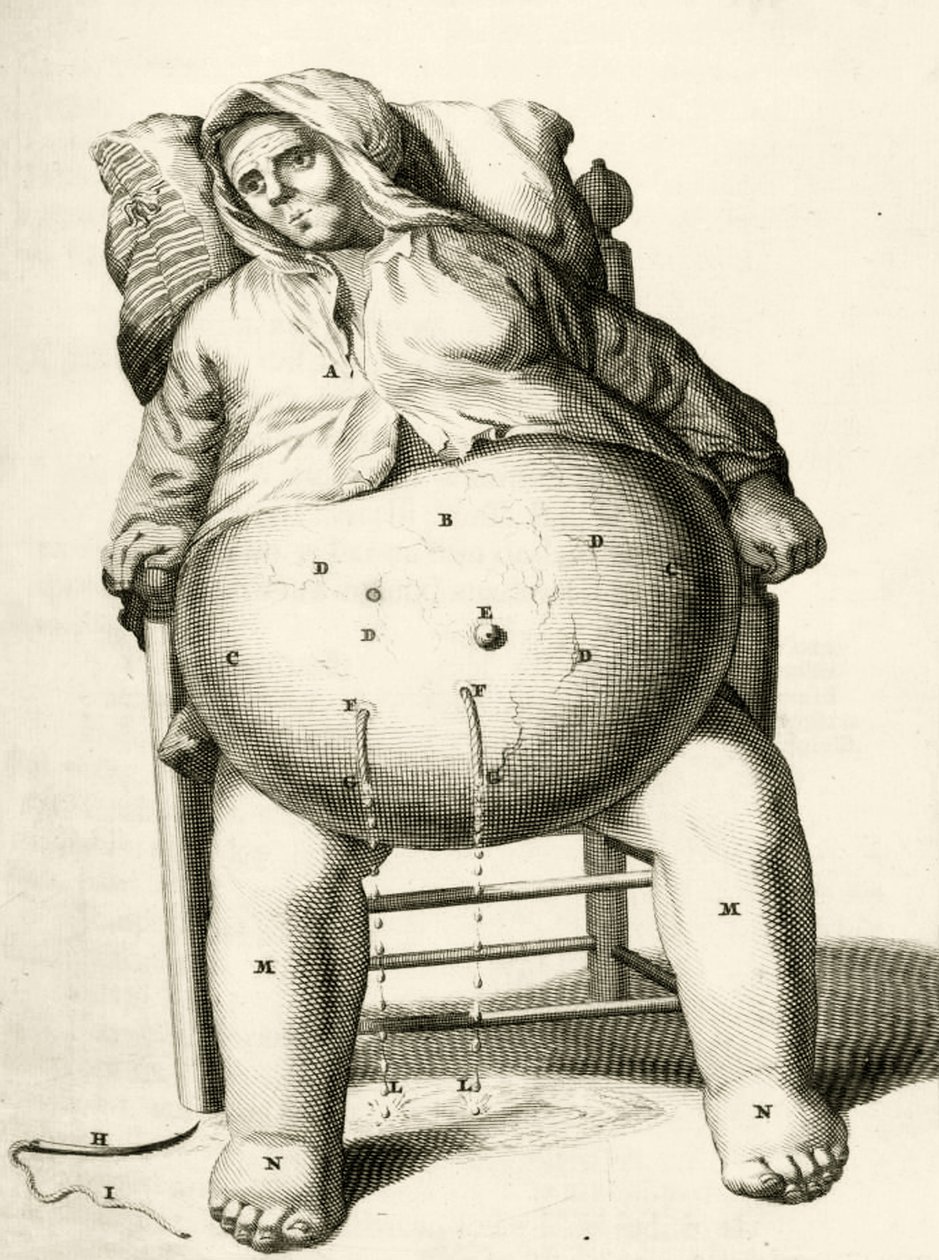 Drenaggio di liquidi da un ascesso, da Exercitationes Practicae circa Medendi Methodum di Frederik Dekkers, 1694 da Dutch School
