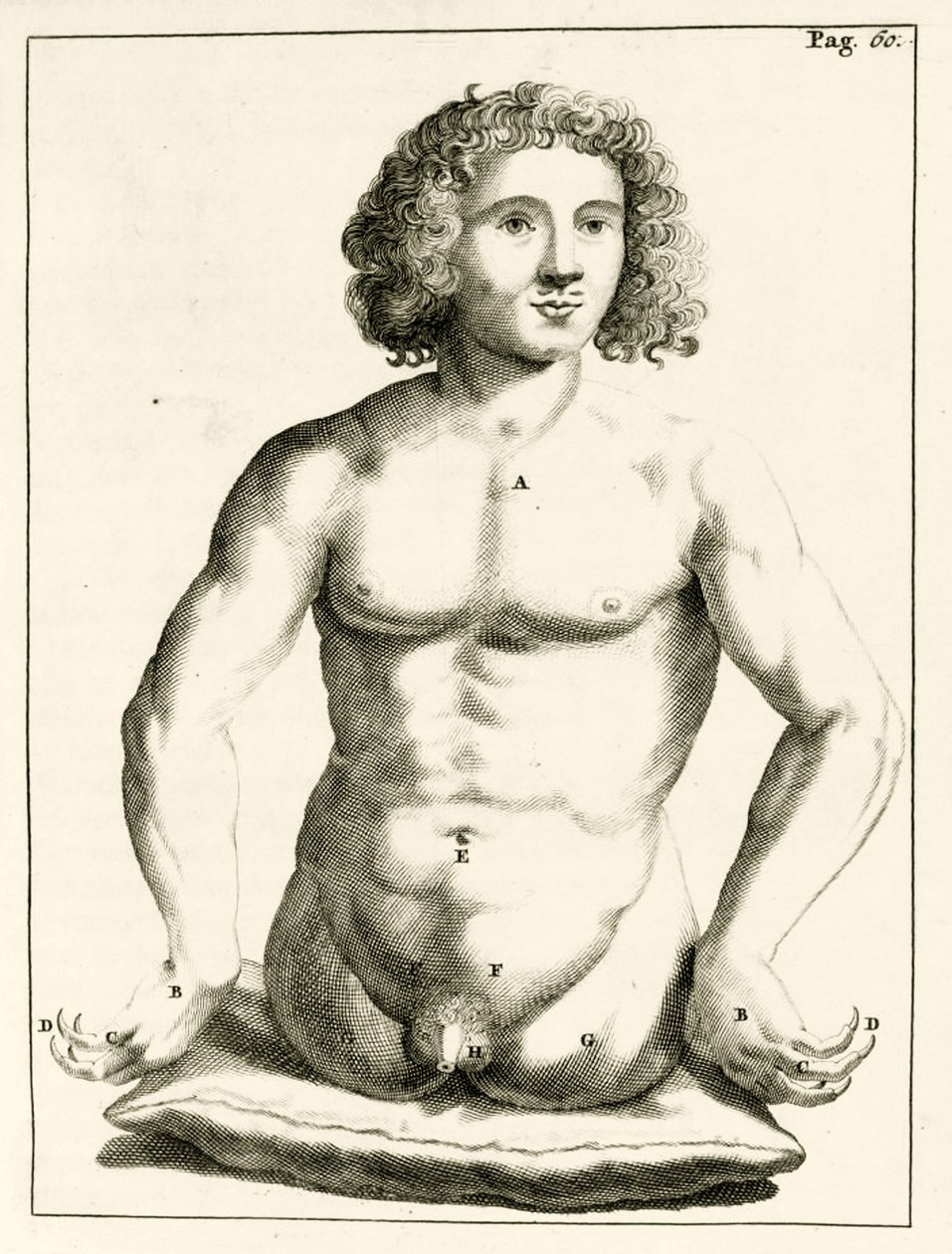 Esempio di difetti congeniti, da Exercitationes Practicae circa Medendi Methodum di Frederik Dekkers, 1694 da Dutch School