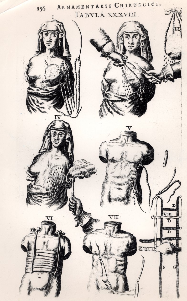 Operazione per il cancro al seno, da Armamentarii Chirurgici di Johannes Schultes pubblicato ad Amsterdam, 1672 da Dutch School