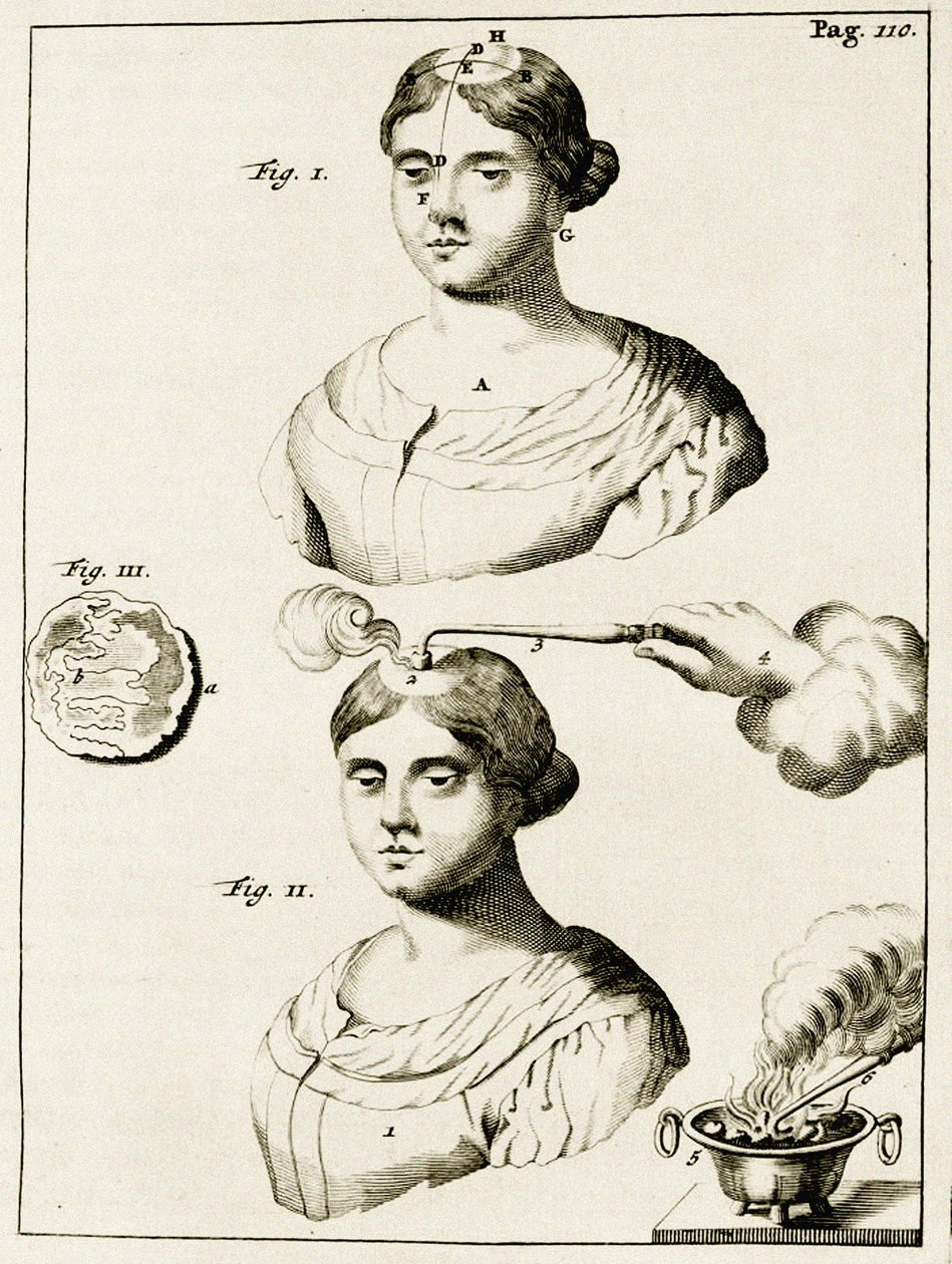 Trattamento di un epilettico, da Exercitationes Practicae circa Medendi Methodum di Frederik Dekkers, 1694 da Dutch School