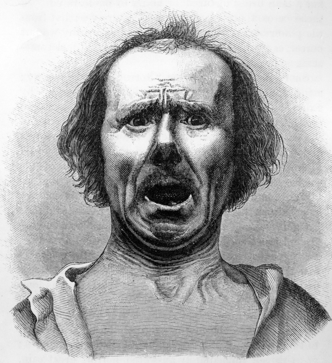 Orrore e Agonia, copiato da una fotografia del Dr. Duchenne, illustrazione da 