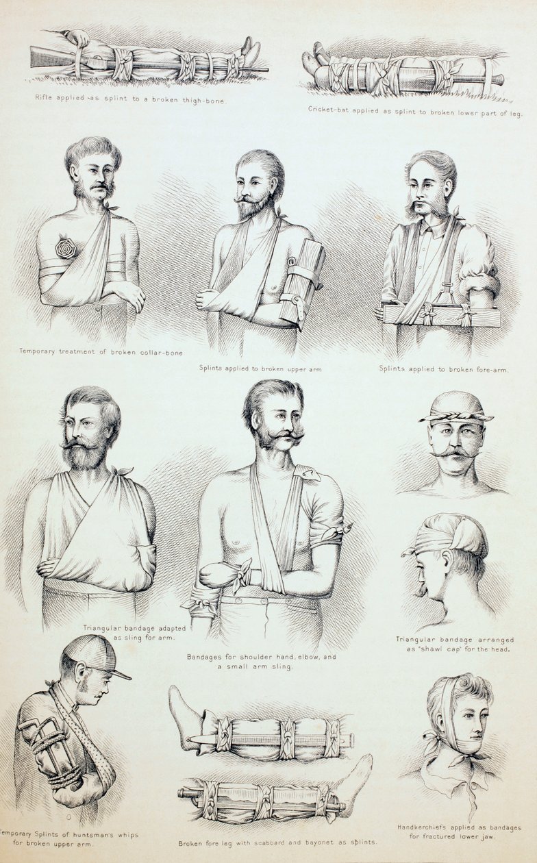 Trattamento temporaneo delle fratture, c.1890 da English School