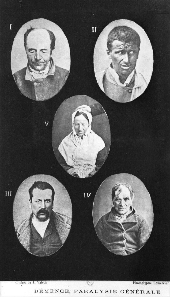 Demenza, Paralisi Generale, illustrazione da Nouveau traité élémentaire et pratique des maladies mentales di Henri Dagonet, Parigi, Baillière, 1876 da French Photographer