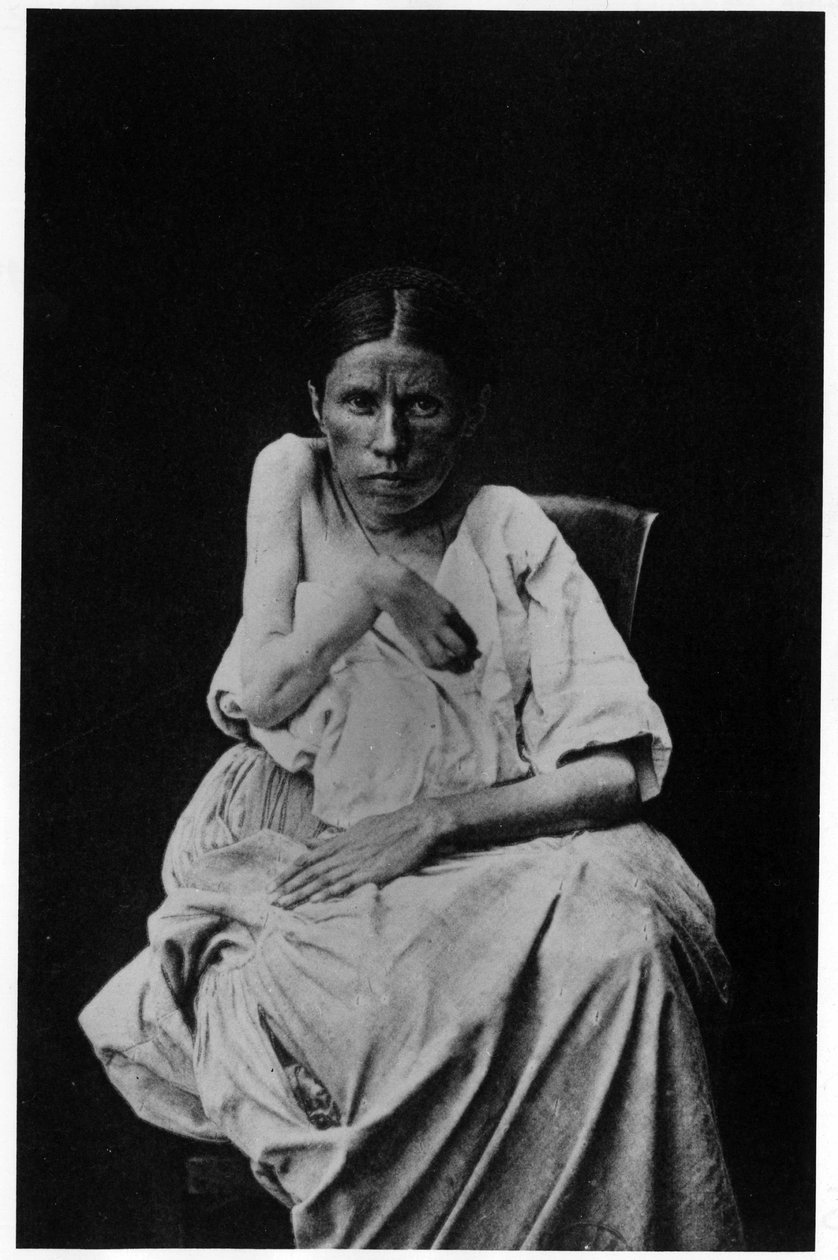 Fotografia di un paziente affetto da epilessia emiplegica, -in "iconografia fotografica della Salpetrière, Bourneville e P. Regnard, Parigi" da French Photographer