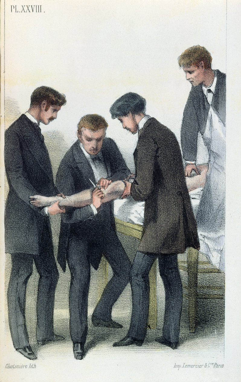 Amputazione di un braccio, da un manuale medico di Jean-Baptiste-Leon Dubreuil, c.1850-60 da French School