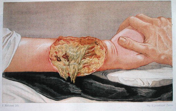 Gangrena ospedaliera, da 