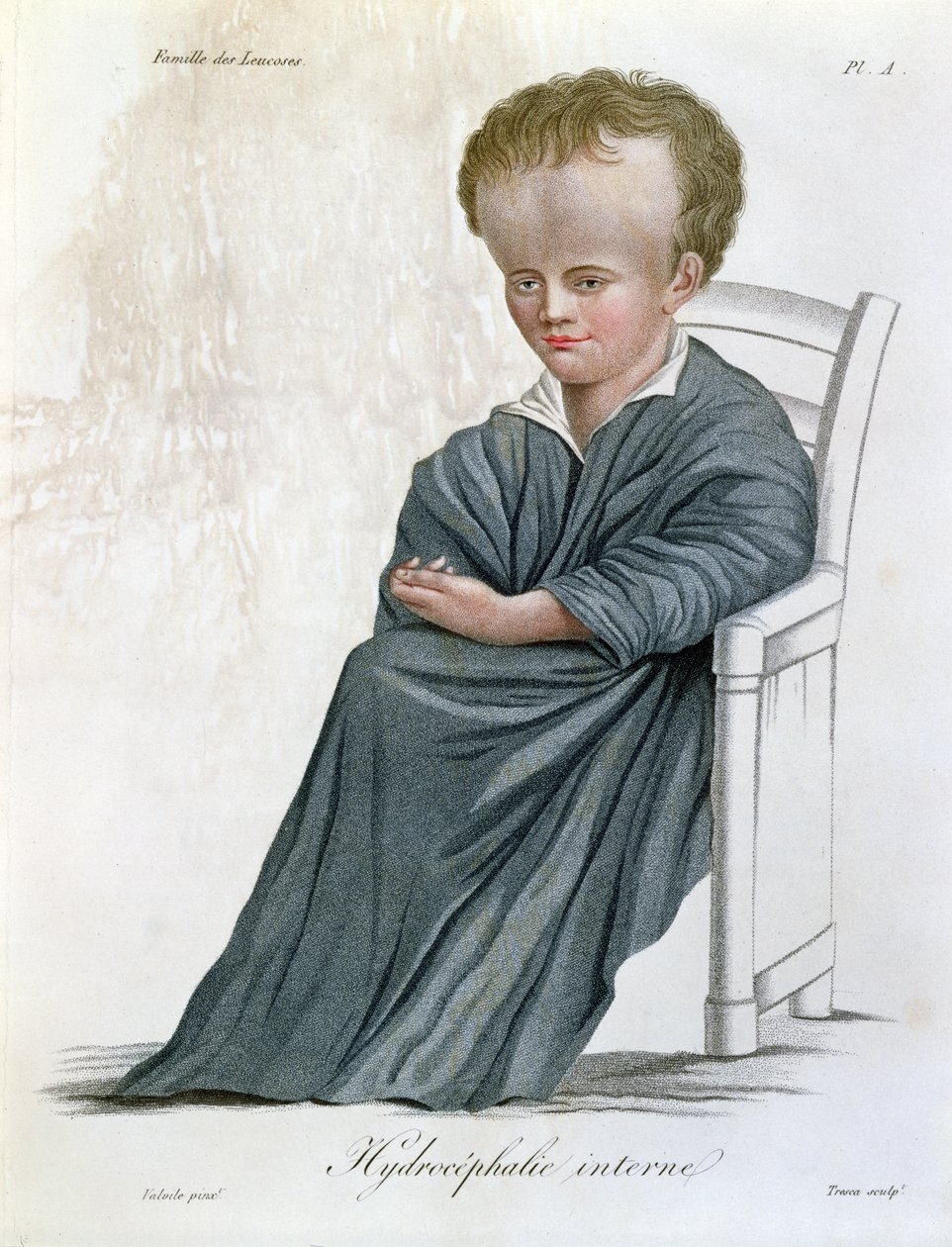 Idrocefalo interno, da Nosologie Naturelle di Baron Jean Louis Alibert (1768-1837) inciso da Tresca, 1817 da French School
