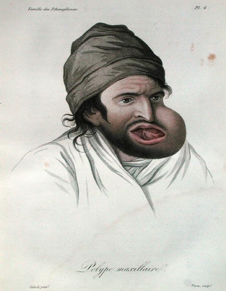 Polipo mascellare, da un libro di Baron Jean Louis Alibert da French School