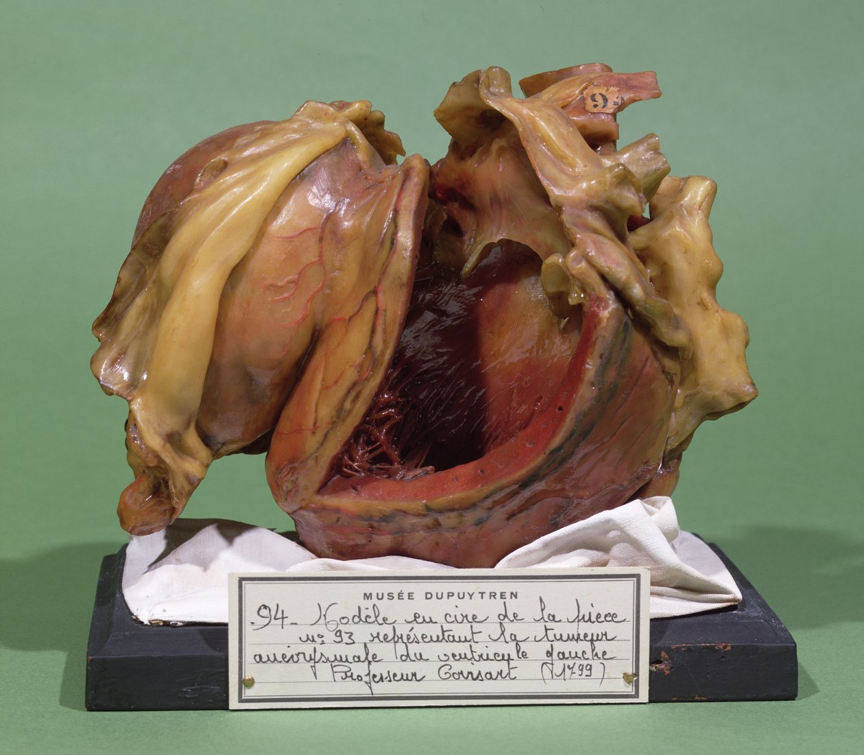 Modello di un tumore del ventricolo sinistro, 1799 da French School