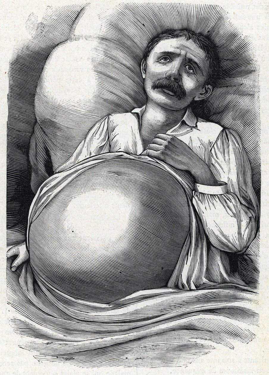 Paziente con cirrosi epatica avanzata (incisione) 1888 da French School