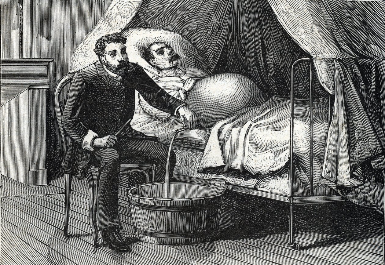 Paziente con cirrosi epatica avanzata, medico che esegue una puntura (incisione) 1888 da French School