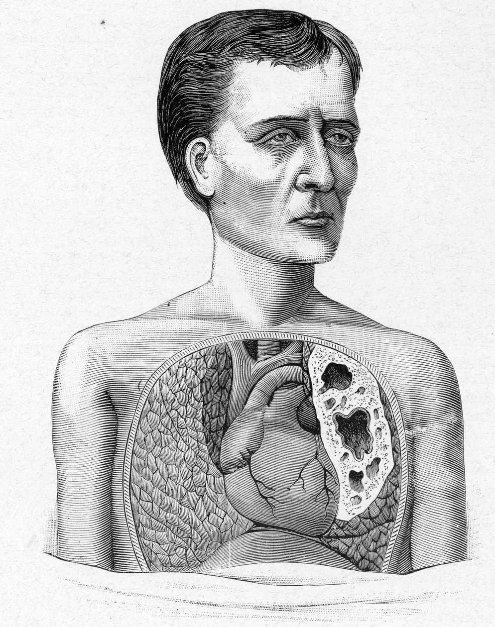 Rappresentazione di una persona con caverne, complicazione della tubercolosi (incisione) da French School