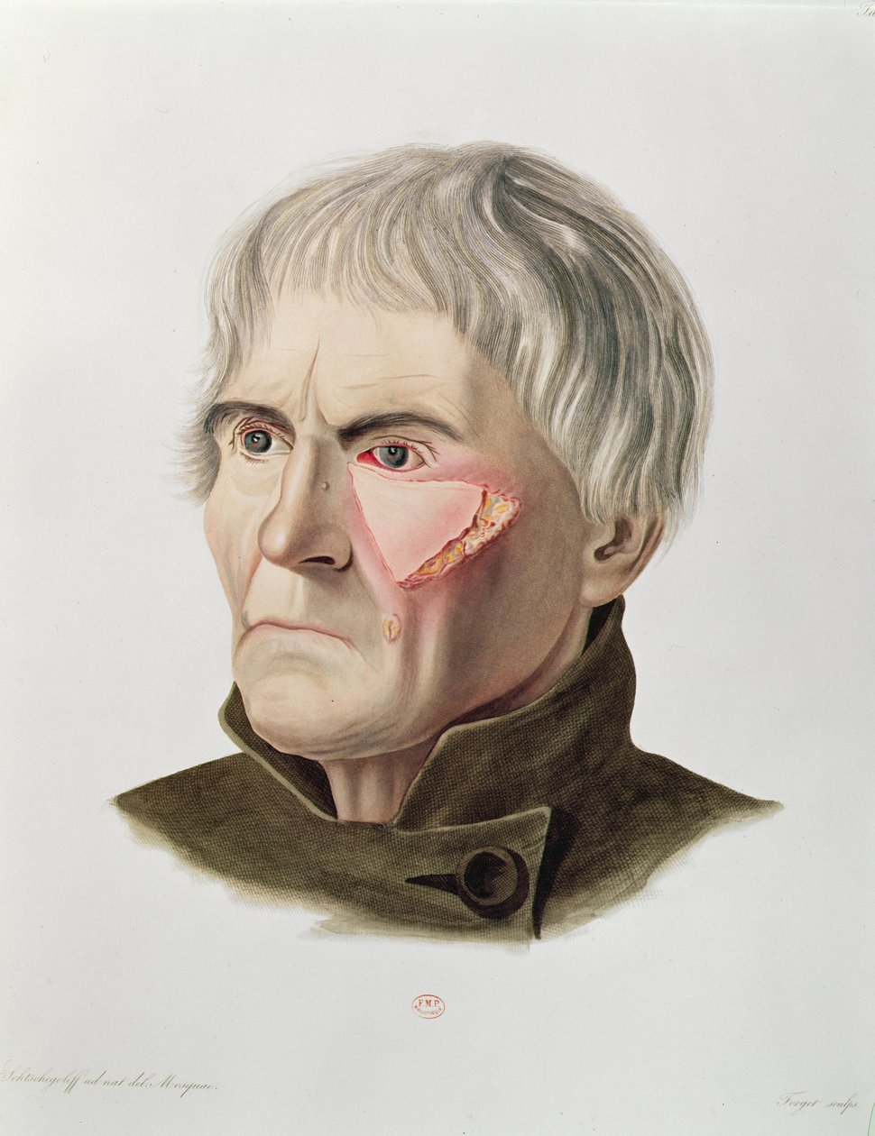 Operazione di innesto cutaneo, da Selecta Praxis Medico-Chirurgica di Alexander Auvert, Parigi, 1856 da French School
