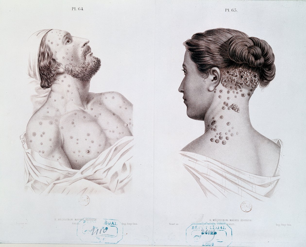 Sintomi della sifilide negli uomini e nelle donne, da un libro medico, c.1850-60 da French School