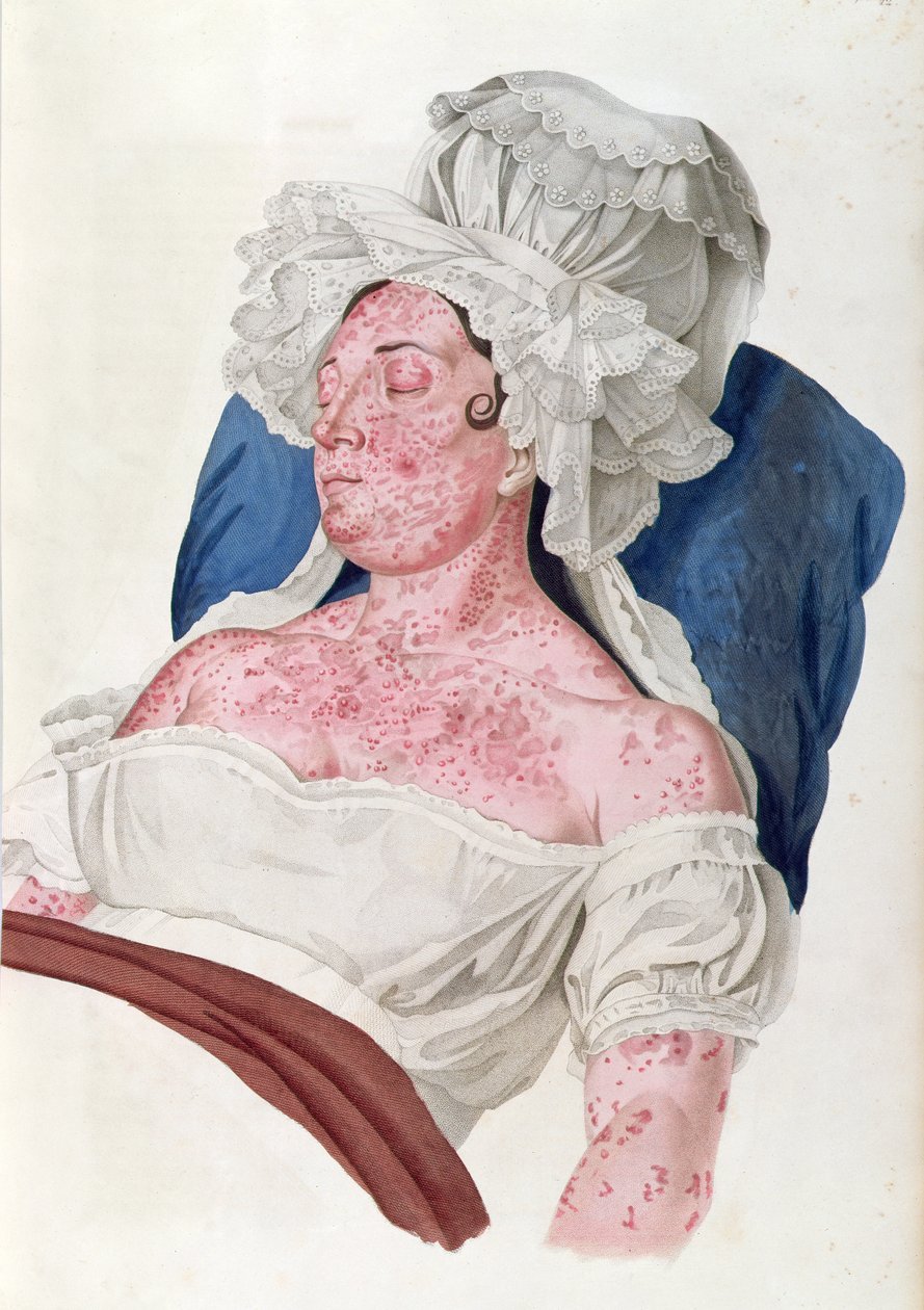 Donna con scarlattina, da un libro di Baron Jean Louis Alibert (1768-1837) inciso da Choupard, 1833 da French School