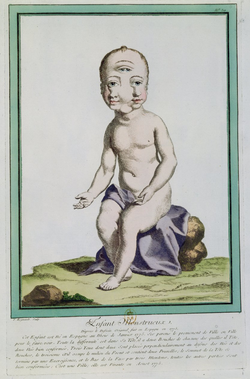Bambino con testa deformata, da 