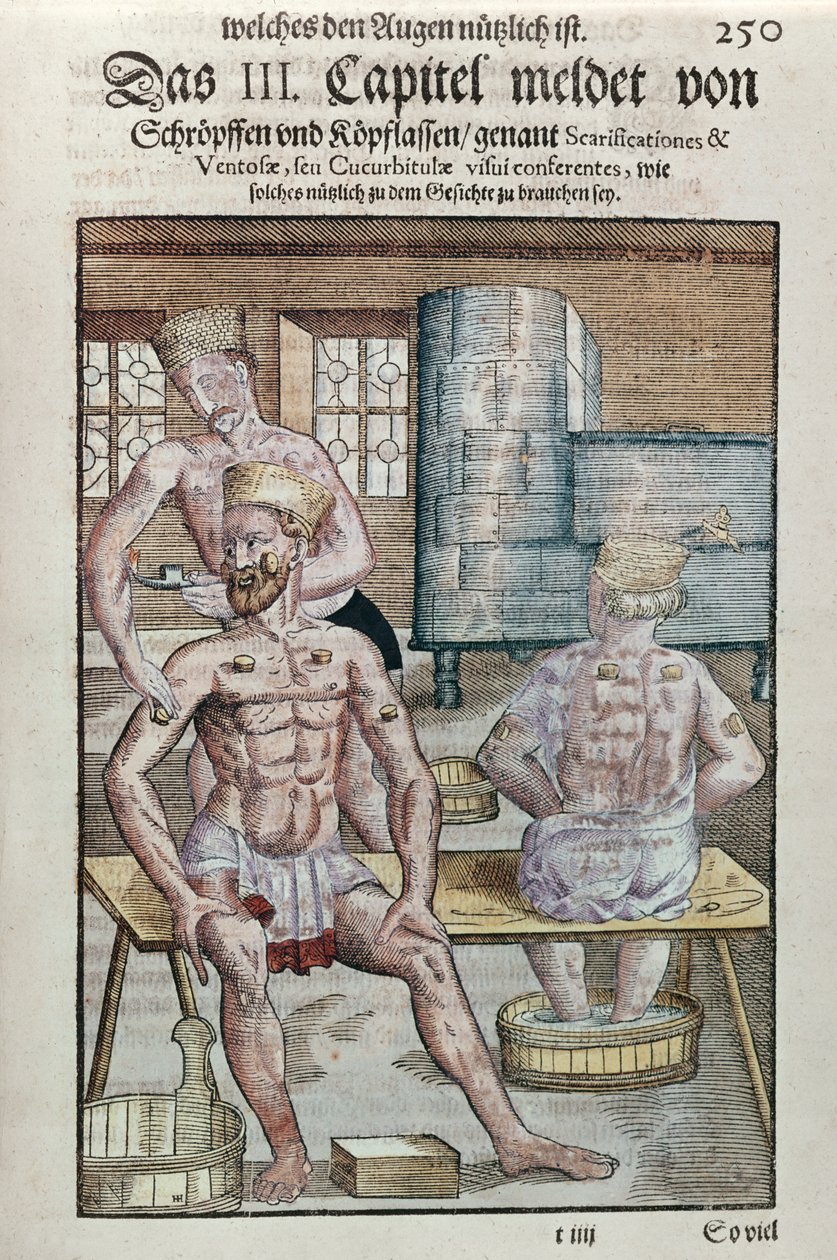 Coppettazione, da Ophthalmodouleia di Georg Bartisch (1535-1636) pubblicato a Dresda nel 1583 (stampa a blocchi di legno a colori) da German School
