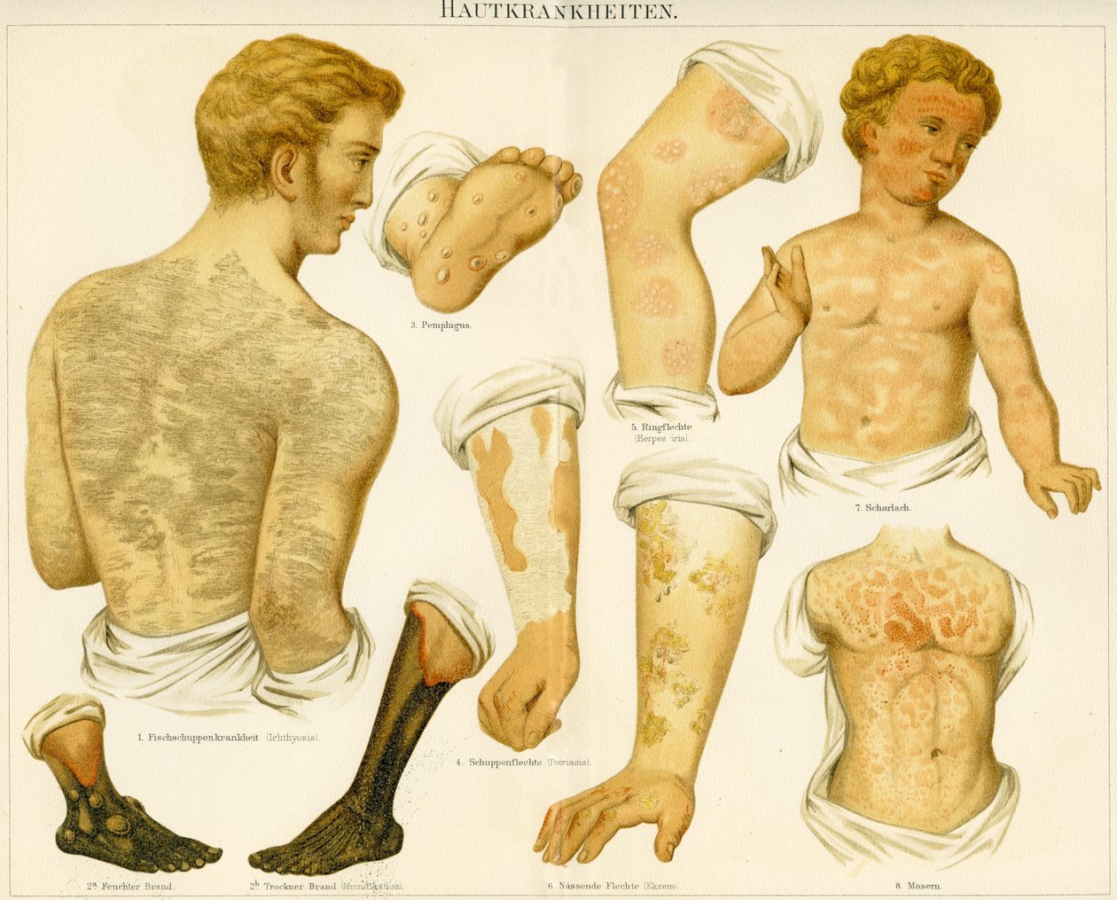 Disturbi della pelle, c.1890 da German School