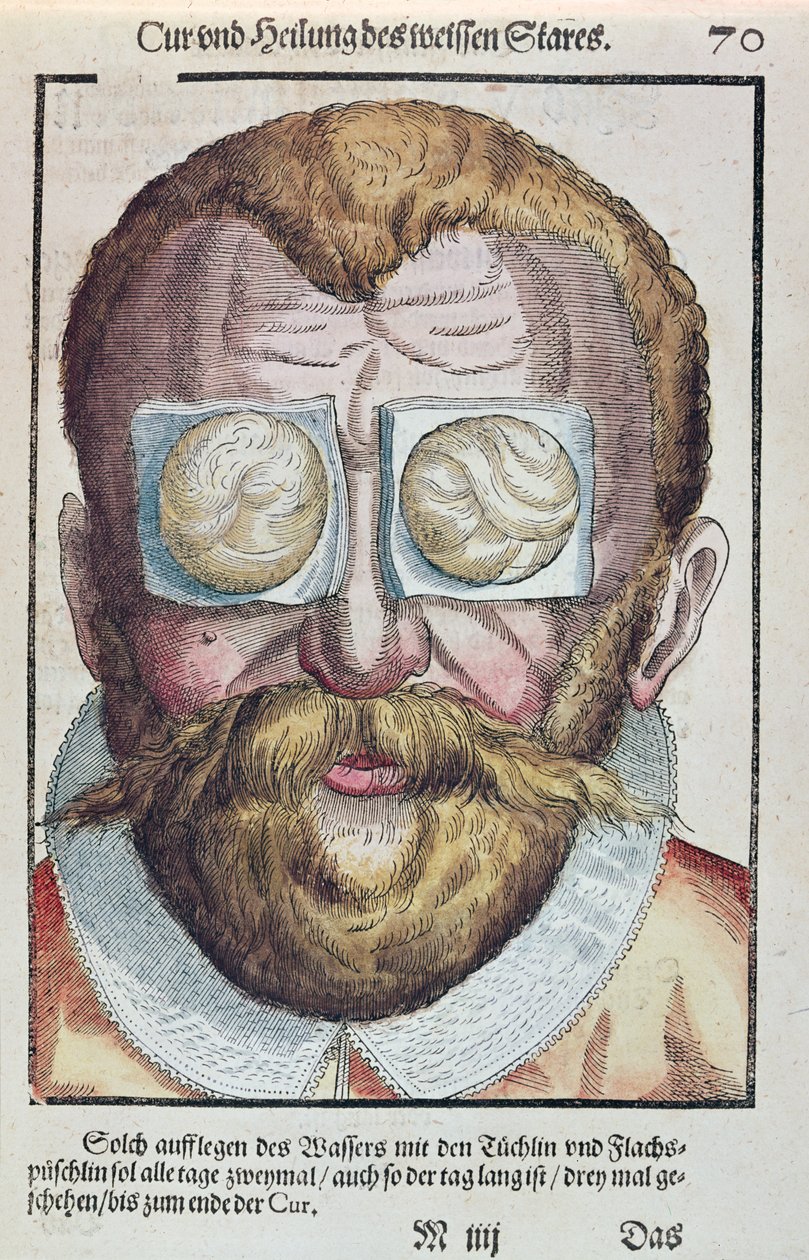 Trattamento di una condizione oculare, da Ophthalmodouleia di Georg Bartisch (1535-1636) pubblicato a Dresda nel 1583 da German School