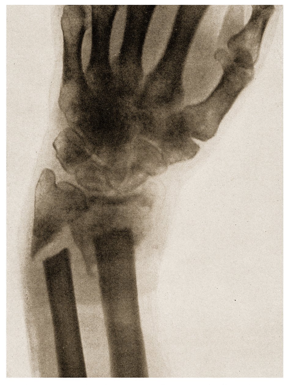 Radiografia di un polso fratturato c.1890 da German School