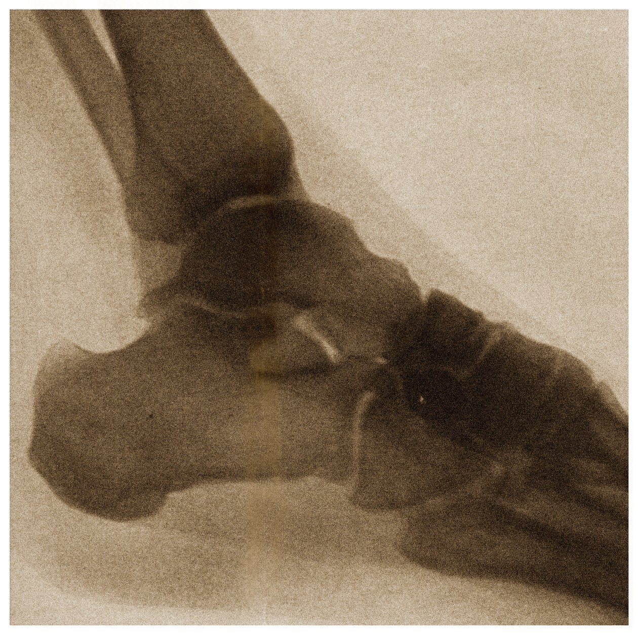 Radiografia di una caviglia c.1890 da German School