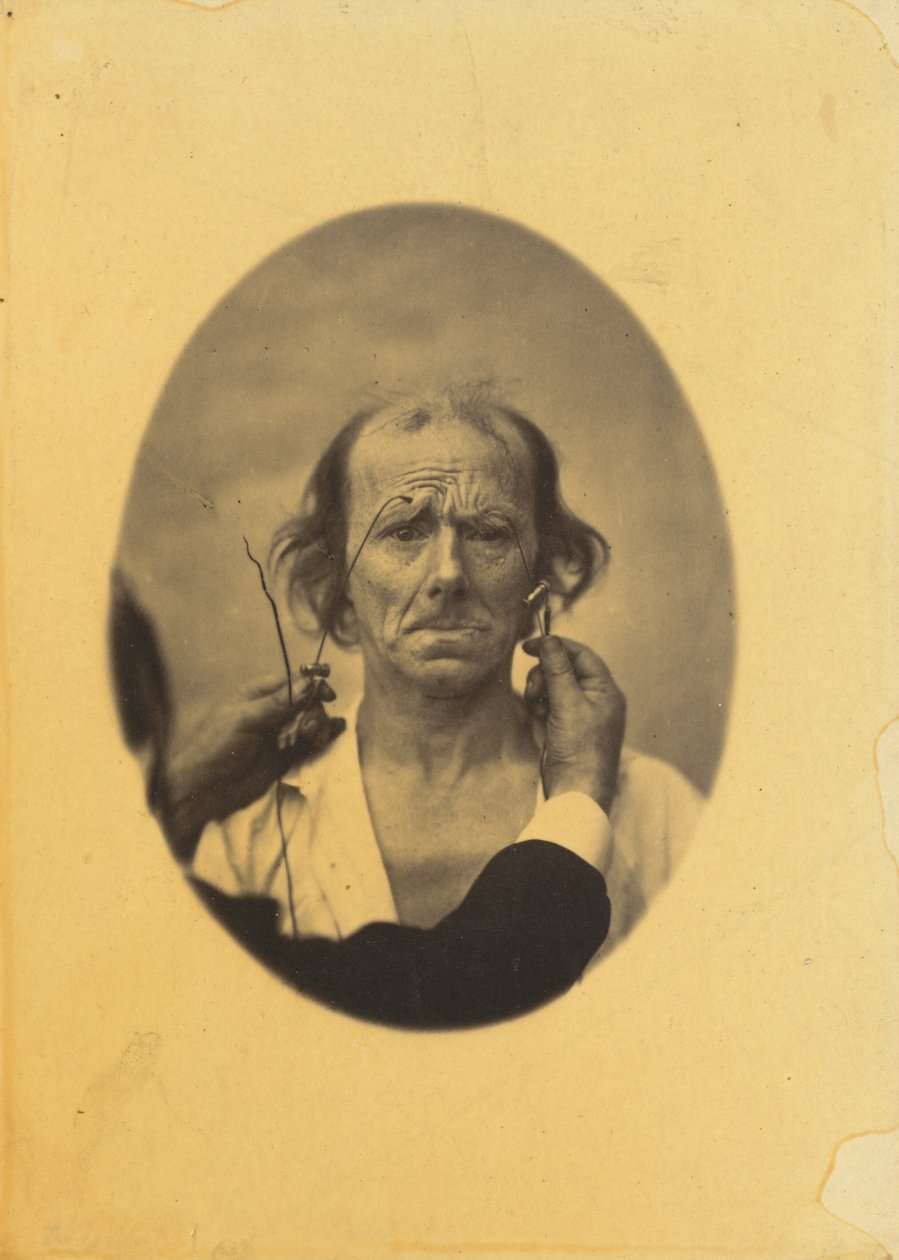 Insoddisfazione, pensieri cupi (sinistra); Riflessione (destra) da Guillaume Benjamin Amant Duchenne