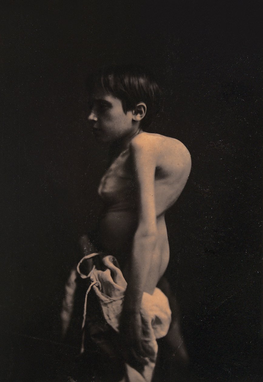 Ritratto di un ragazzo gobbo da Guillaume Benjamin Armand Duchenne de Boulogne
