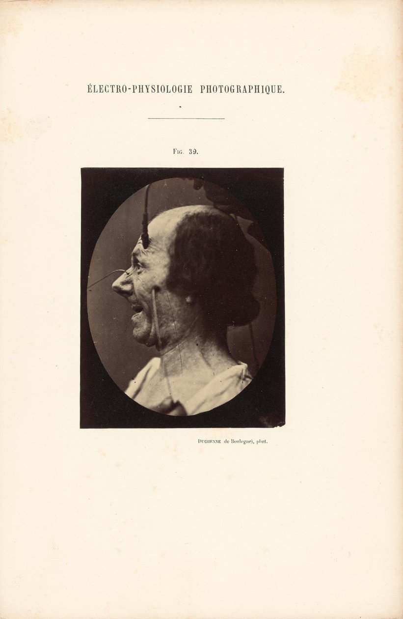 Elettrofisiologia fotografica, Figura 39 da Guillaume Benjamin Duchenne