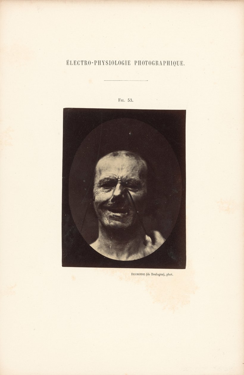 Elettrofisiologia fotografica, Figura 53 da Guillaume Benjamin Duchenne