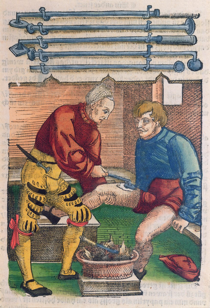 Cauterizzazione, illustrazione da 
