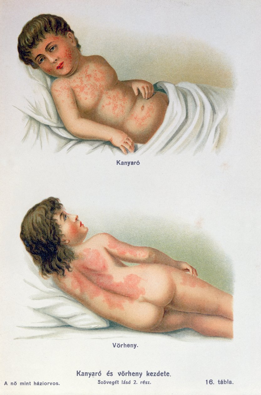 Morbillo e scarlattina, da un libro medico di famiglia, c.1900 da Hungarian School