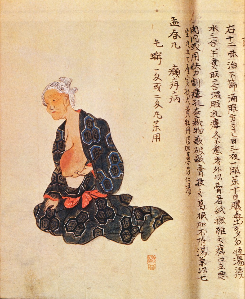 Il primo trattamento chirurgico del cancro al seno eseguito sotto anestesia generale da Seishu Hanaoka (1760-1836) nel 1804 da Japanese School