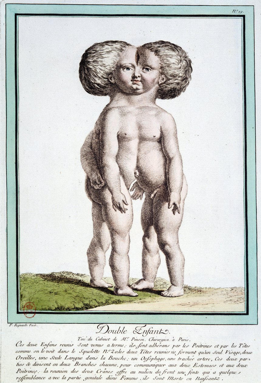 Bambini siamesi - in "Le deviazioni della natura" di Régnault da Jean Baptiste Regnault