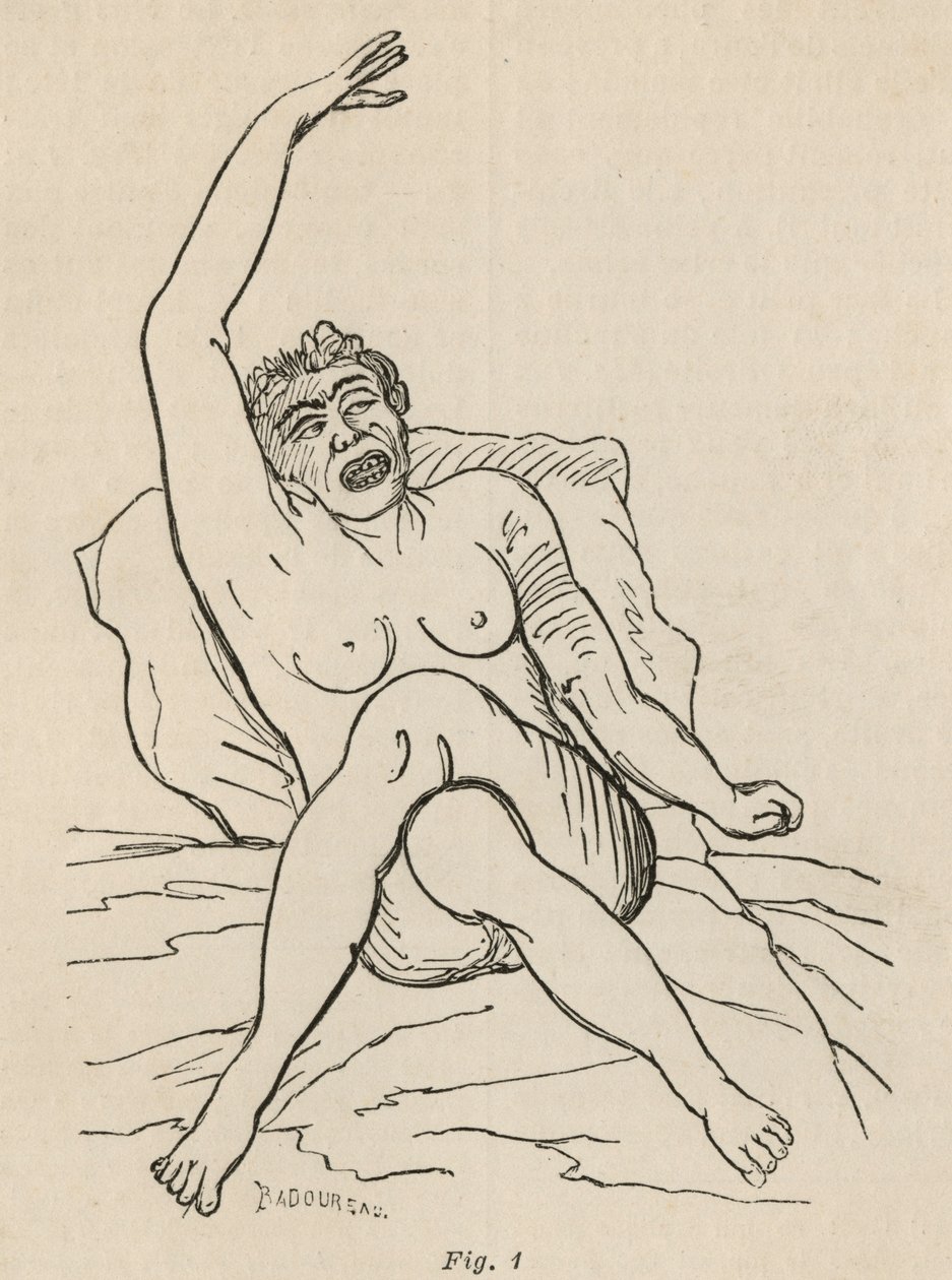 Epilepsia isterica, attacco, contorsioni, fig. 1 da 