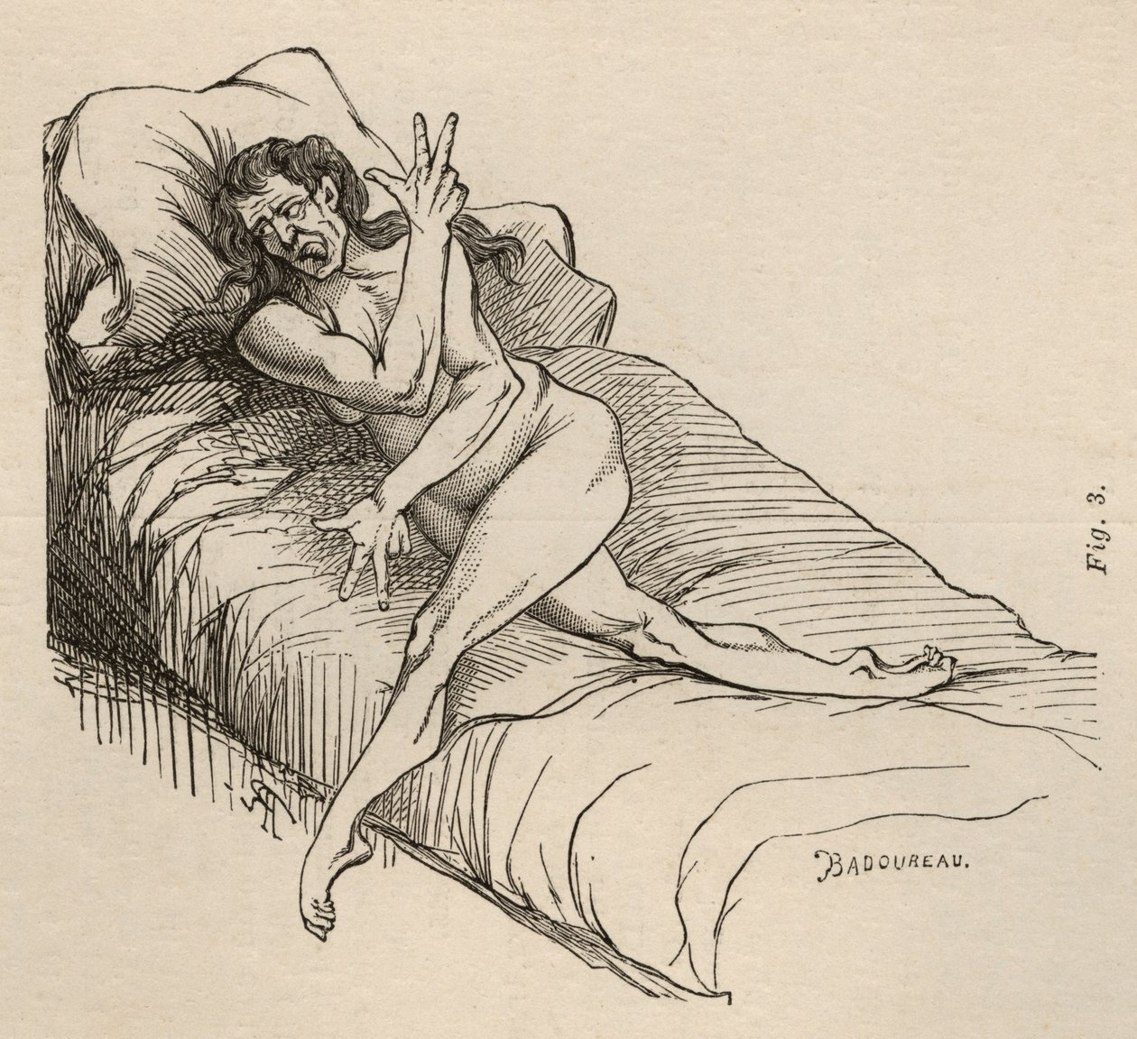 Epilepsia isterica, attacco, contorsioni, fig. 3 da 
