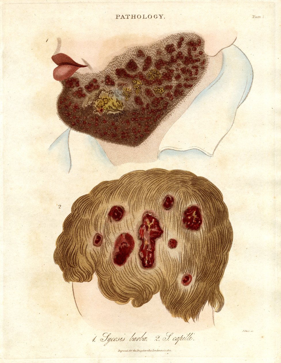 Illustrazione patologica della Sycosis barbae e della Sycosis capilli da John Pass